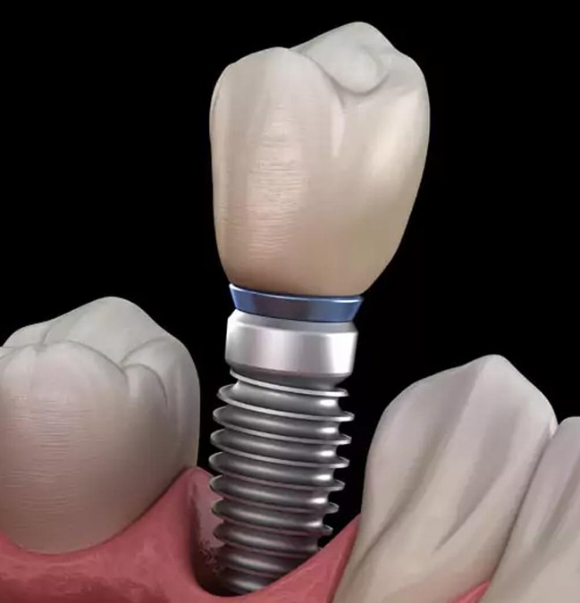 dental implant