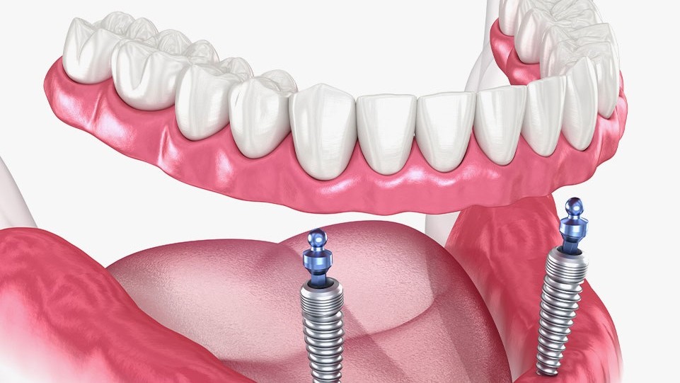 dental implants