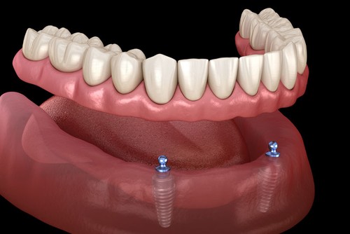 implant supported dentures