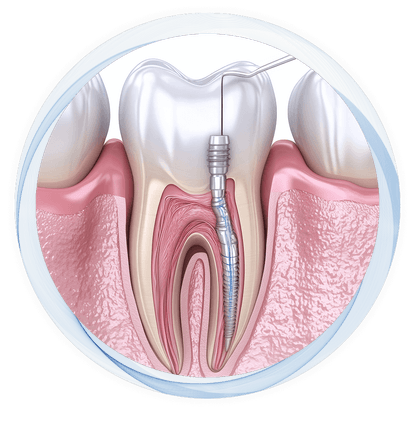tooth with root canal treatment